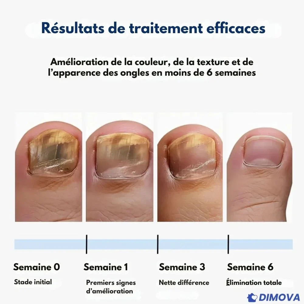 Pansements antimycosiques pour la nuit (Boîte de 60 pansements)